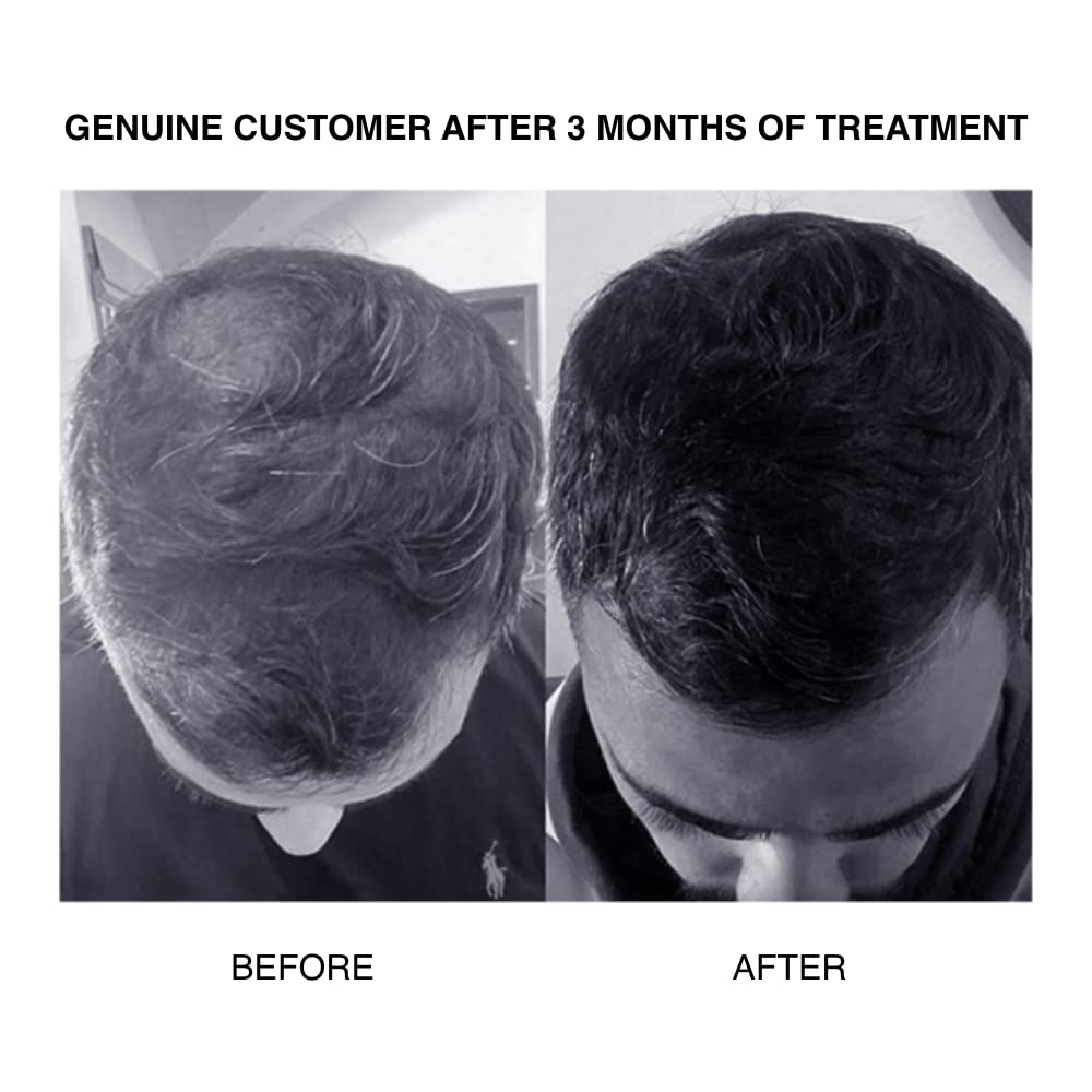 PATRICKS CD Plus Ultra Thickening Conditioner with DHT Blocker - Zinc Enriched Hair Growth Treatment for Moderate to Advanced Hair Loss (200mL) - Revitalize Thinning Hair for Men & Women at Home or Salon