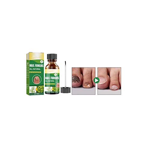 Extra Strength Toenail Fungus Treatment - Fast-Acting Nail Renewal Solution for Damaged & Discolored Fingernails & Toenails - Effective Fungal Nail Repair for Athletes & Pedicure Lovers (1 Pack)