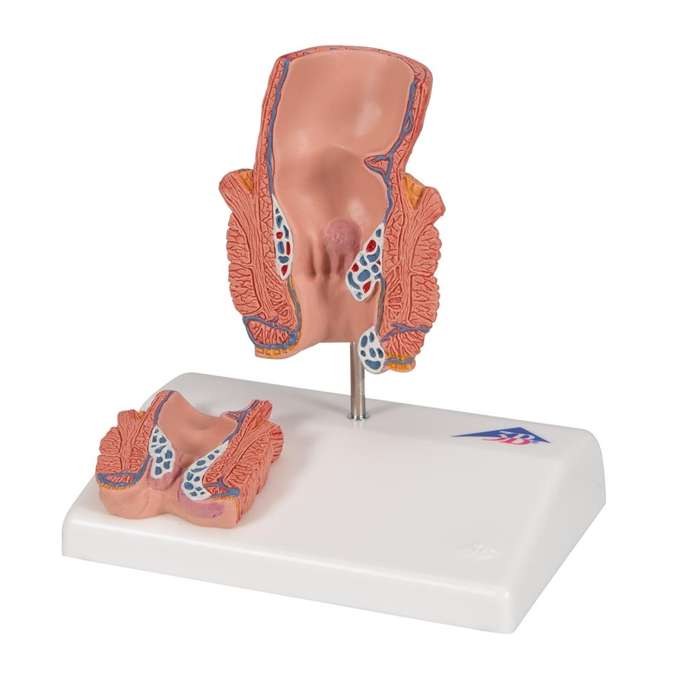 Premium Hemorrhoid Anatomy Model for Medical Training & Patient Education – Ideal for Doctors, Nurses & Healthcare Professionals