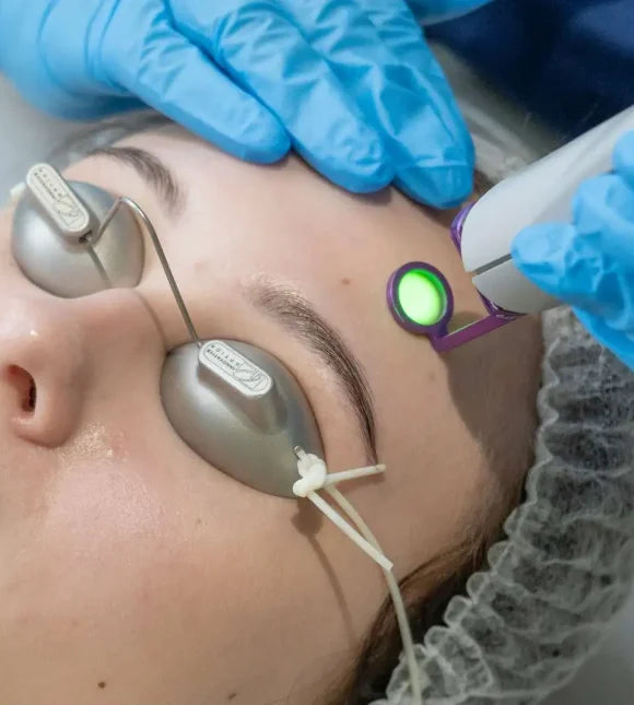 Vbeam Laser Treatment for Skin - Professional Vascular Lesion Removal & Rosacea Therapy - Perfect for Dermatology Clinics & At-Home Skin Care