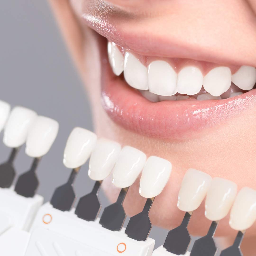 Premium Teeth Whitening Kit with 2 x 4ml Carbamide Peroxide Pens (35% Whitening Gel) - Made in USA - Brighten Smile for Weddings, Photos & Special Occasions