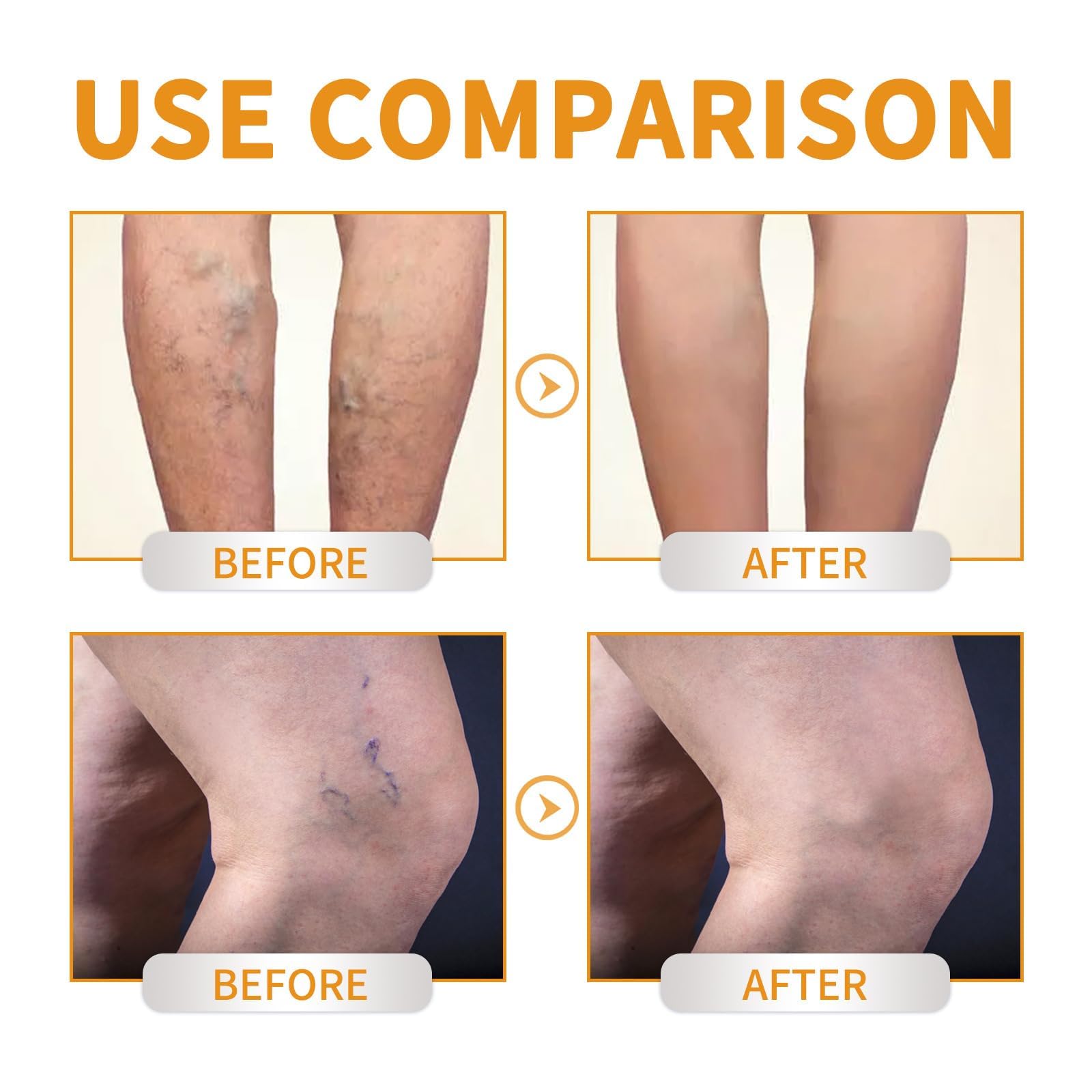 Best Varicose Veins Repair Cream with Vitamin K - Leg Vein Treatment for Men & Women - Soothing Relief for Spider Veins & Swollen Legs - Perfect for Daily Use at Home, Work or Travel