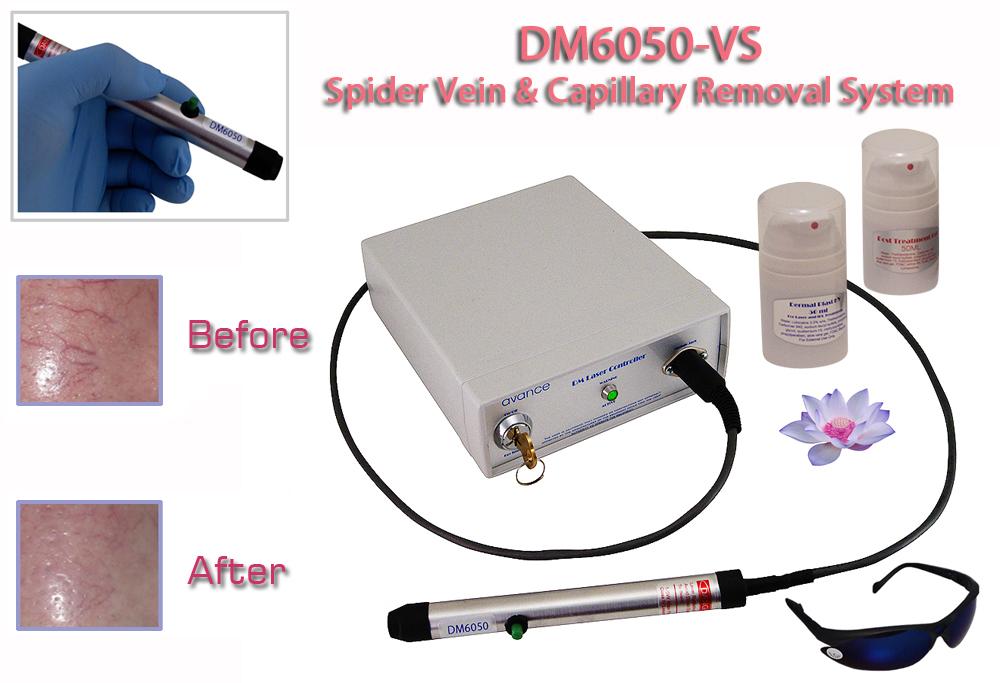Spider Vein Removal Device - Effective Treatment for Spider Veins & Varicose Veins - Home Use for Leg Circulation & Cosmetic Improvement
