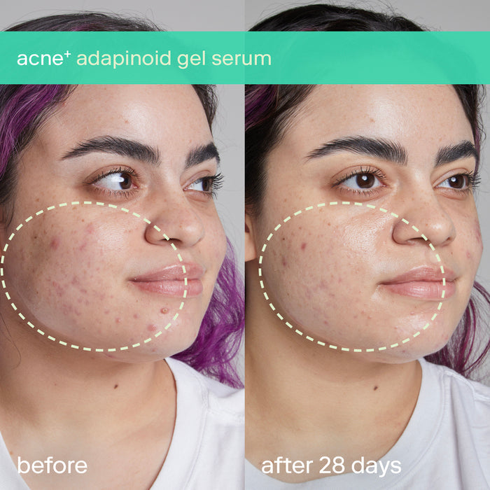 Mini Acne+ Adapinoid® Gel 7ml (0.23 fl.oz) - Dermatologist-Recommended Acne Treatment for Clear Skin | Perfect for Travel & Daily Skincare Routine