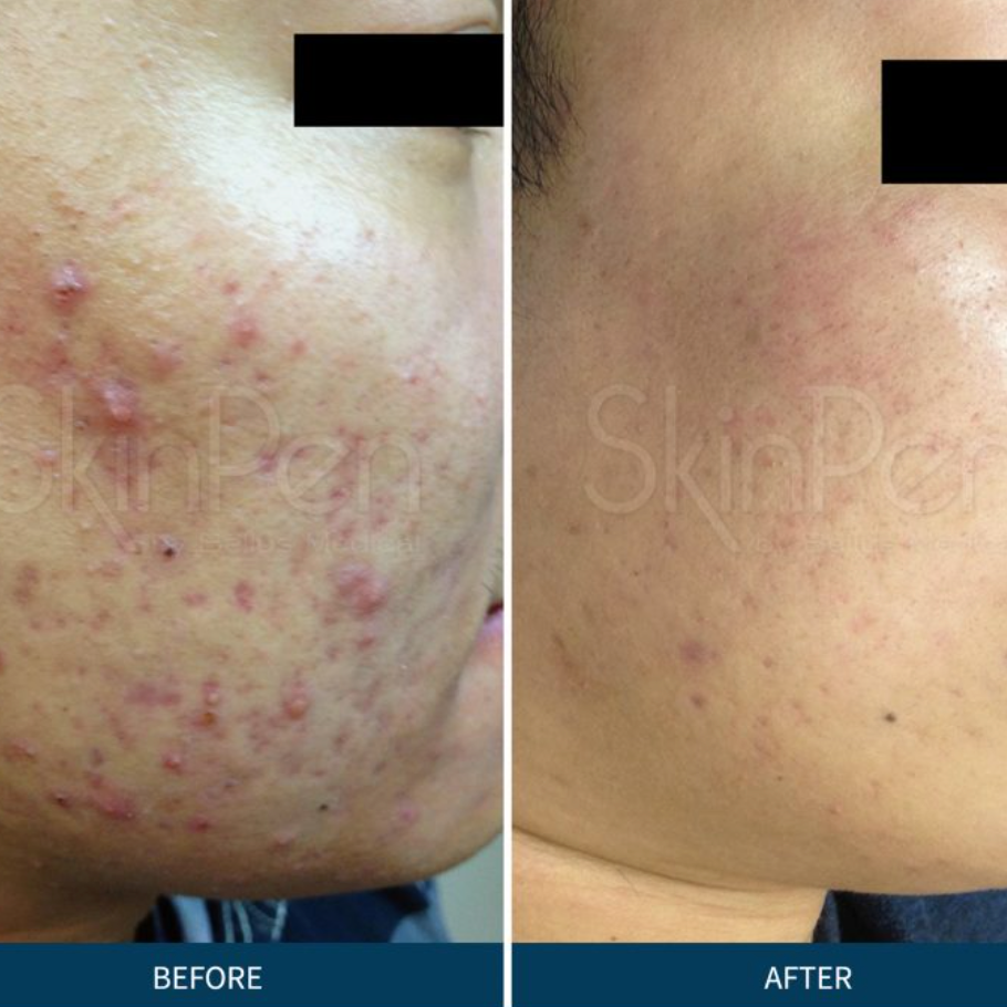 SkinPen® Microneedling Device for Face - Professional At-Home Collagen Induction Therapy | Anti-Aging & Skin Rejuvenation Treatment | Perfect for Wrinkles, Acne Scars & Uneven Skin Tone
