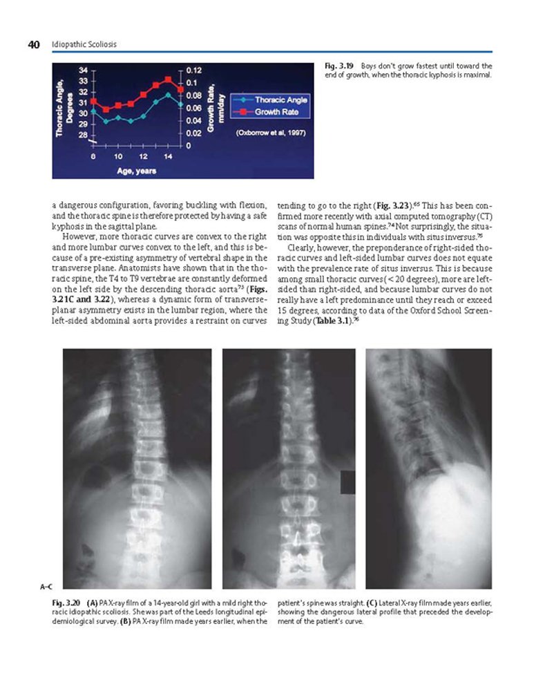 Idiopathic Scoliosis Treatment Guide - Harms Study Group Recommendations for Spinal Correction & Pain Relief | For Doctors, Physical Therapists & Patients