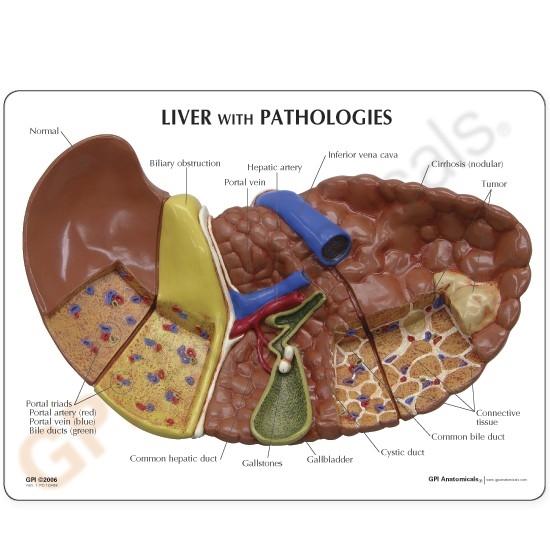 Human Diseased Liver (Cancer) Anatomy Model - Detailed Medical Study Tool for Doctors, Students & Researchers | Perfect for Medical Education, Diagnosis Practice & Pathology Studies