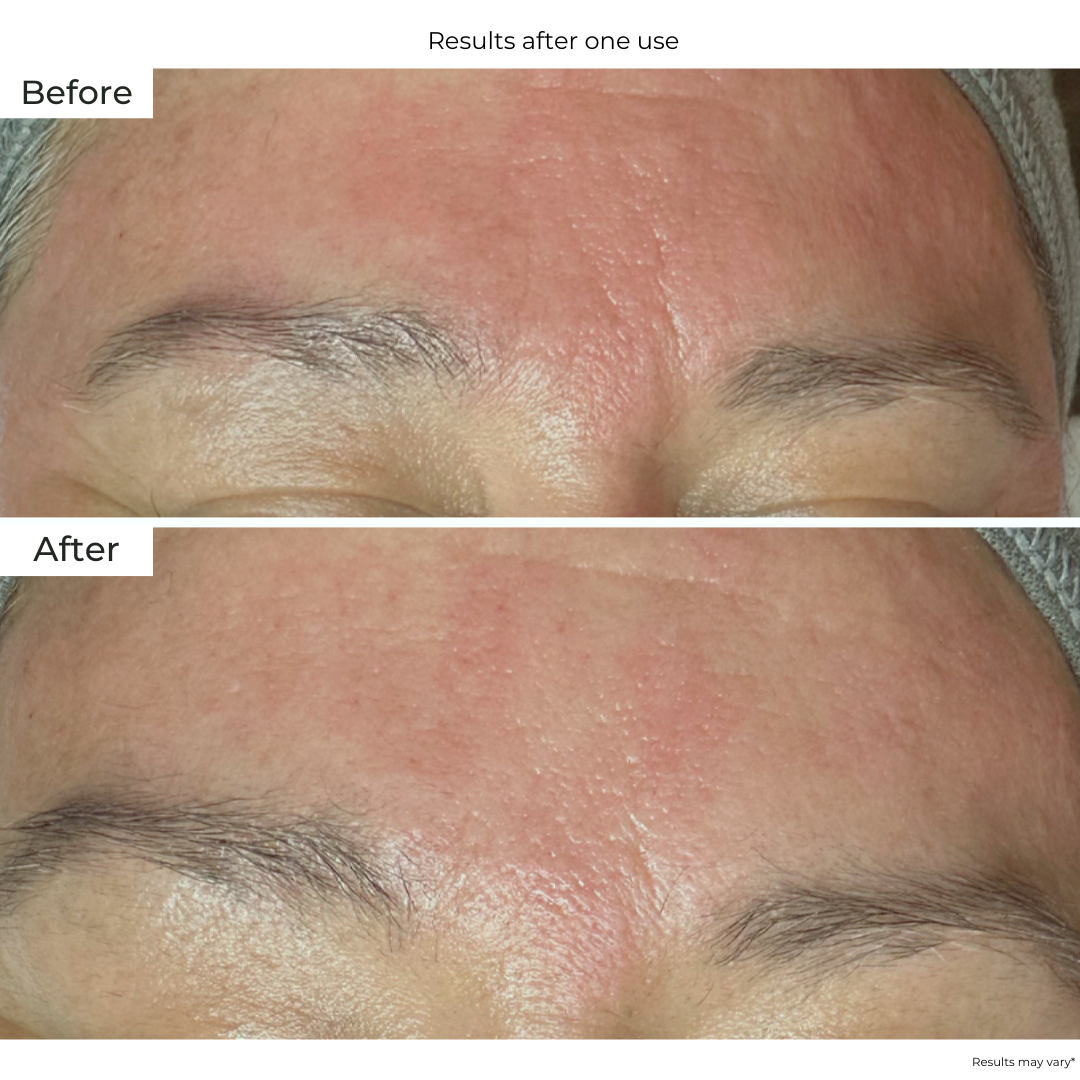 Boto Needle Frown Line Patch - Anti-Wrinkle Forehead Patches for Forehead Lines & Expression Wrinkles | Reduce Fine Lines & Smooth Skin | Perfect for Nighttime Skincare & Pre-Makeup Application