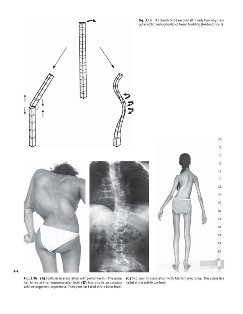 Idiopathic Scoliosis Treatment Guide - Harms Study Group Recommendations for Spinal Correction & Pain Relief | For Doctors, Physical Therapists & Patients