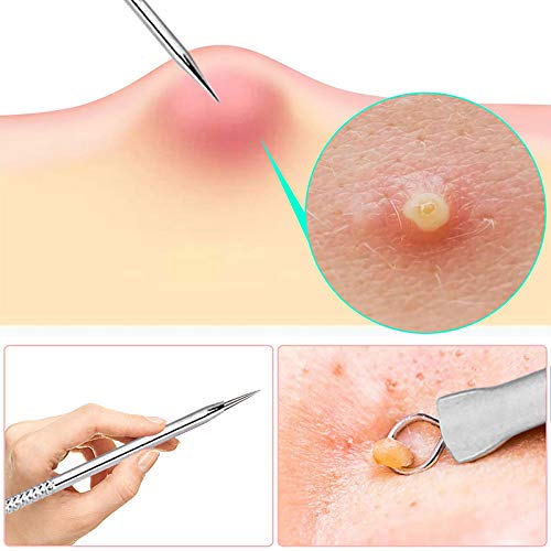 Anjetan 7PCS Blackhead Tweezers Kit - Professional Stainless Steel Acne Removal Tools with Travel Case - Blackhead Extractor, Pimple Popper & Blemish Remover Set for Face & Body Care - Perfect for Home Spa, Travel & Professional Use
