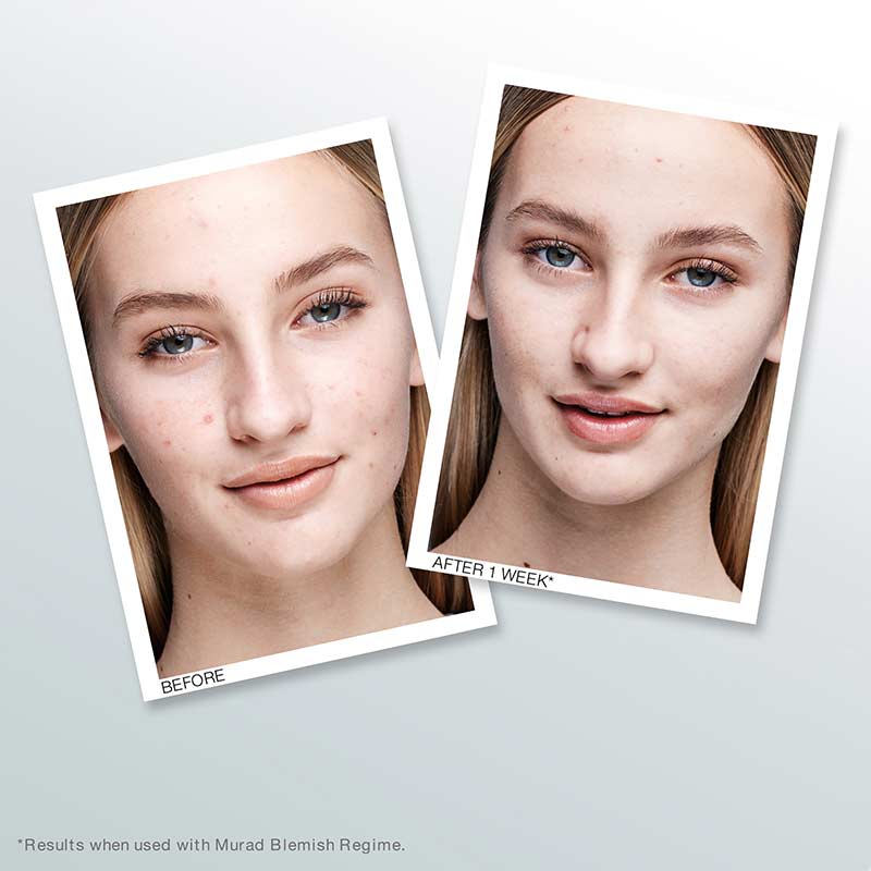 Murad Blemish Control Outsmart Blemish Clarifying Treatment for Acne-Prone Skin | Oil-Free Face Serum for Clear Complexion | Perfect for Daily Skincare Routine & Breakout Prevention