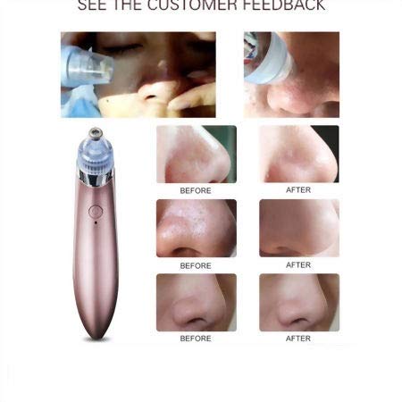 Cpixen USB Rechargeable Blackhead Remover Vacuum Tool - Facial Pore Cleaner for Deep Cleansing, Skin Care & Beauty - Multicolor (Perfect for Home Spa & Travel Skincare Routine)