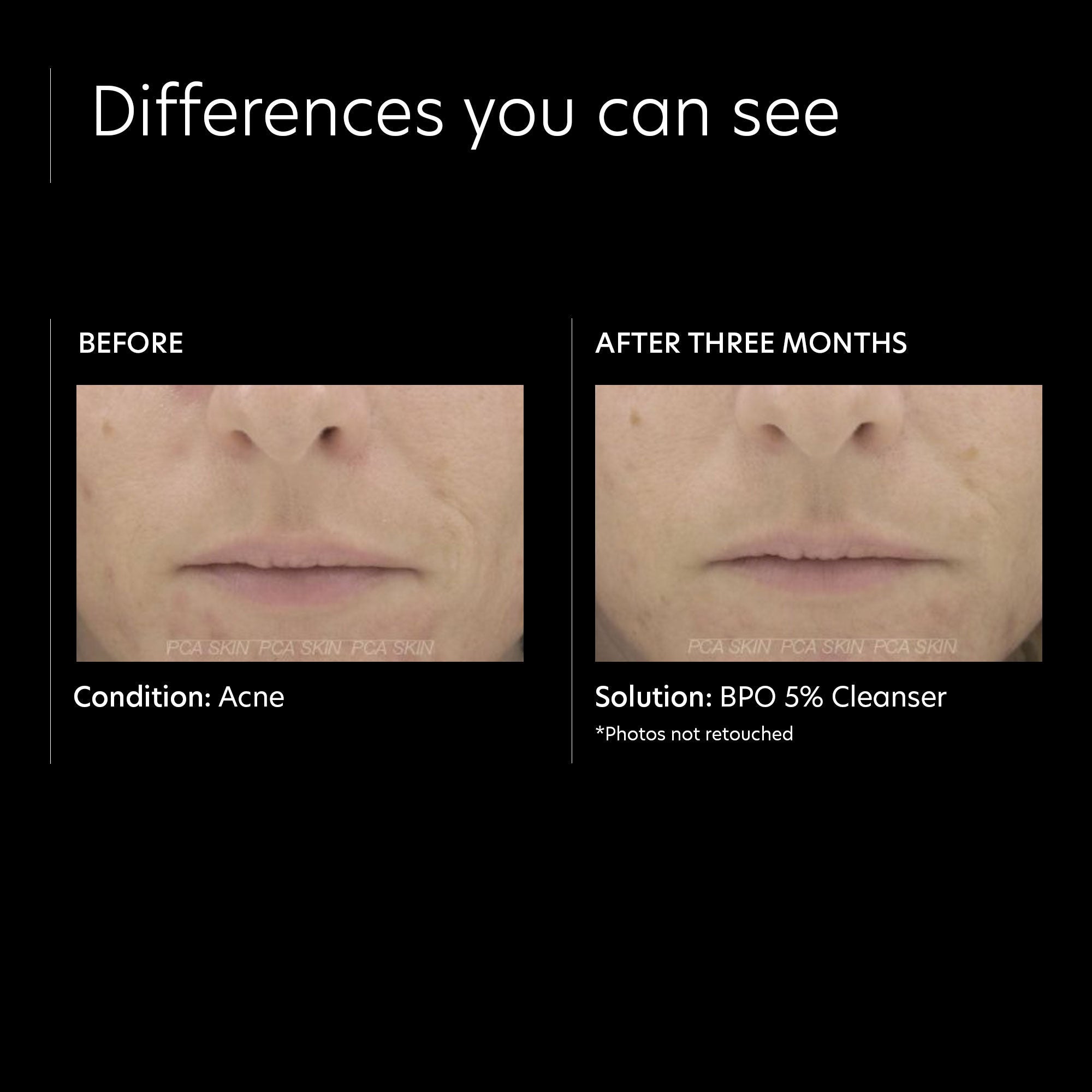 PCA Skin BPO 5% Cleanser - Acne Treatment Face Wash for Oily & Acne-Prone Skin - Daily Use for Clear Complexion | Perfect for Morning & Night Skincare Routine