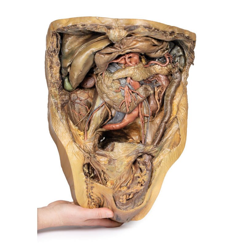 3D Printed Abdomen Model with Inguinal Hernia - Medical Training & Anatomy Study Tool for Students, Doctors & Surgeons