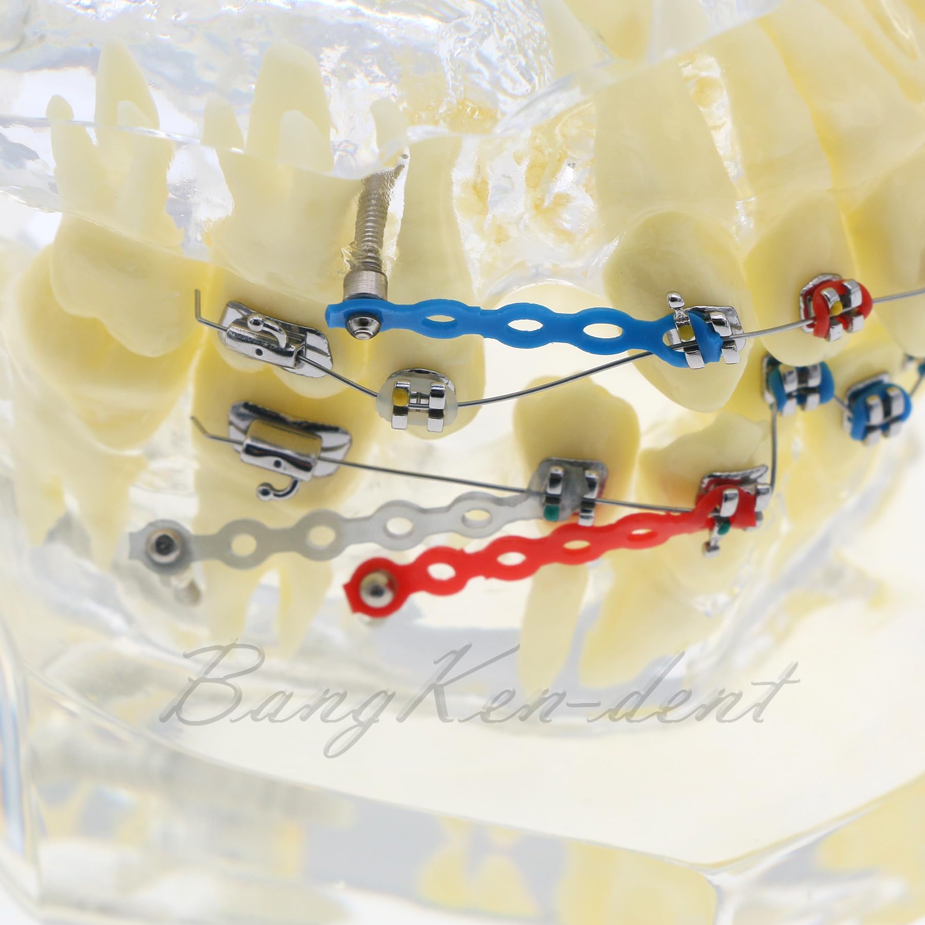 Orthodontic Typodont Dental Model with Braces, Arch Wire, Bracket & Buccal Tube - Premolar Deformity Teaching Demonstration Kit for Dental Students & Professionals (M3005-CLEAR) - Perfect for Dental School Practice, Orthodontic Training & Clinical Demonstrations