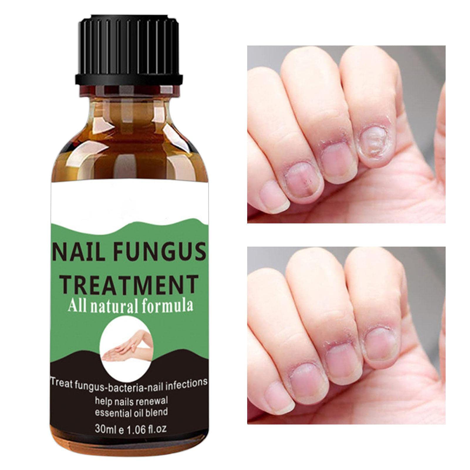 **STENUA 4-Piece Toe Nail Repair & Strengthening Liquid - Restores Healthy Nails, Treats Thick, Broken, Discolored & Cracked Nails - Perfect for Pedicures & At-Home Nail Care**
