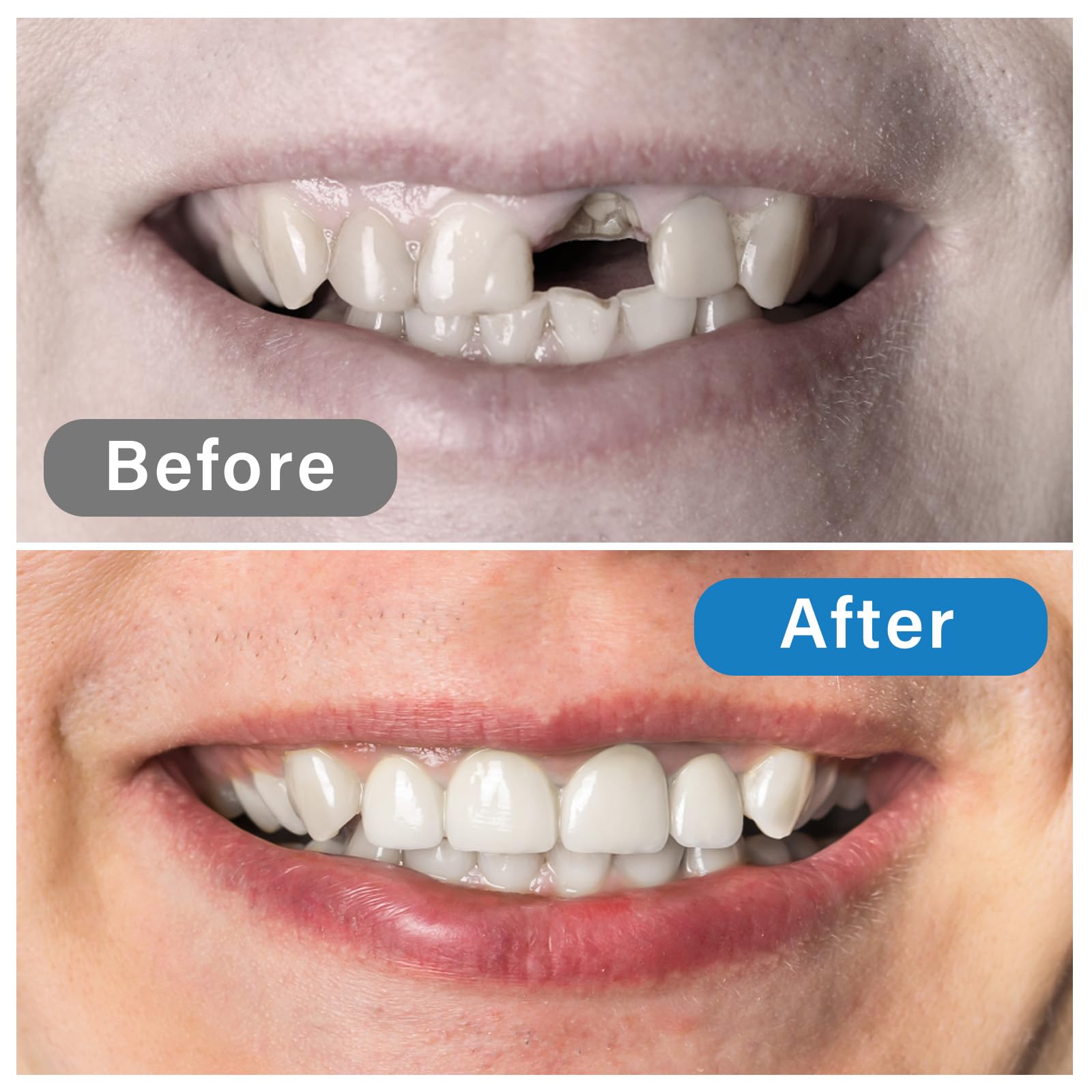 Dental Repair Kit for Broken & Missing Teeth - Temporary Tooth Filling Material, Emergency Dental Care Solution for Pain Relief & Cavity Repair - Regain Confidence with Natural-Looking Smile (Off White) - Perfect for Travel, Home Use & Dental Emergencies