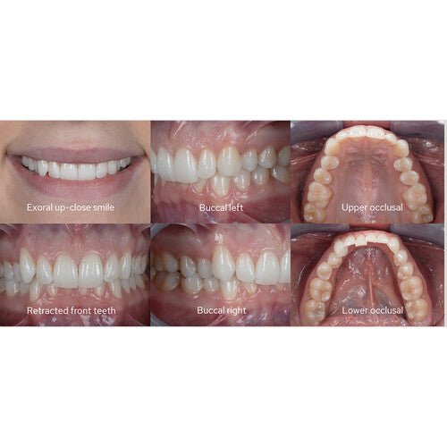 Godox MF12 Dental Macro Flash Kit for Sony Cameras - Professional Dental Photography Lighting for Close-Up Shots, Perfect for Dentists & Orthodontists