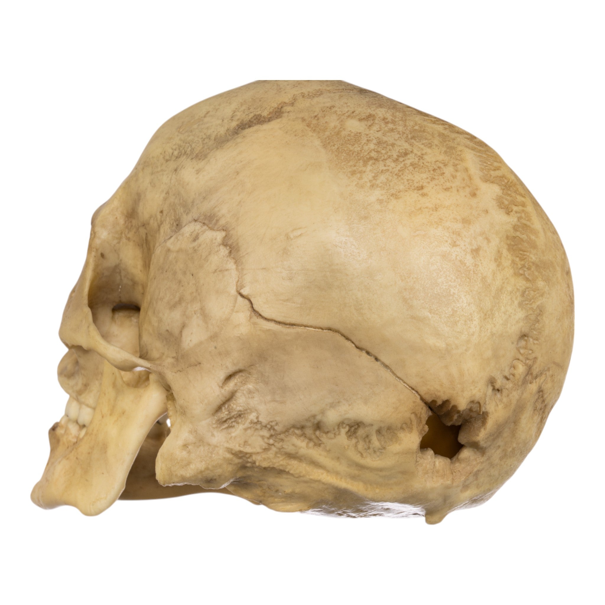 Realistic Replica Human Male Skull with 32 Caliber Gunshot Wound - Perfect for Medical Training, Forensic Studies, and Halloween Decorations