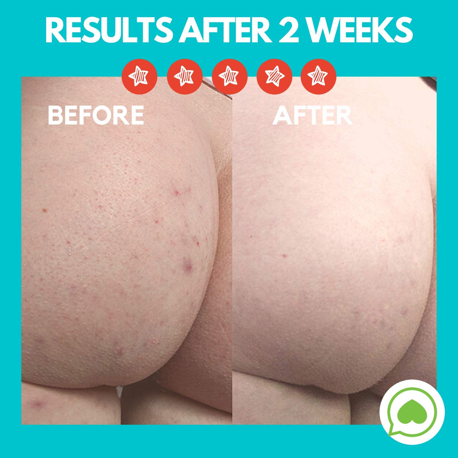 Best Butt Acne Clearing Lotion for Body Breakouts - Fast-Acting Acne Treatment for Back & Bum Pimples - Perfect for Gym-Goers & Active Lifestyles