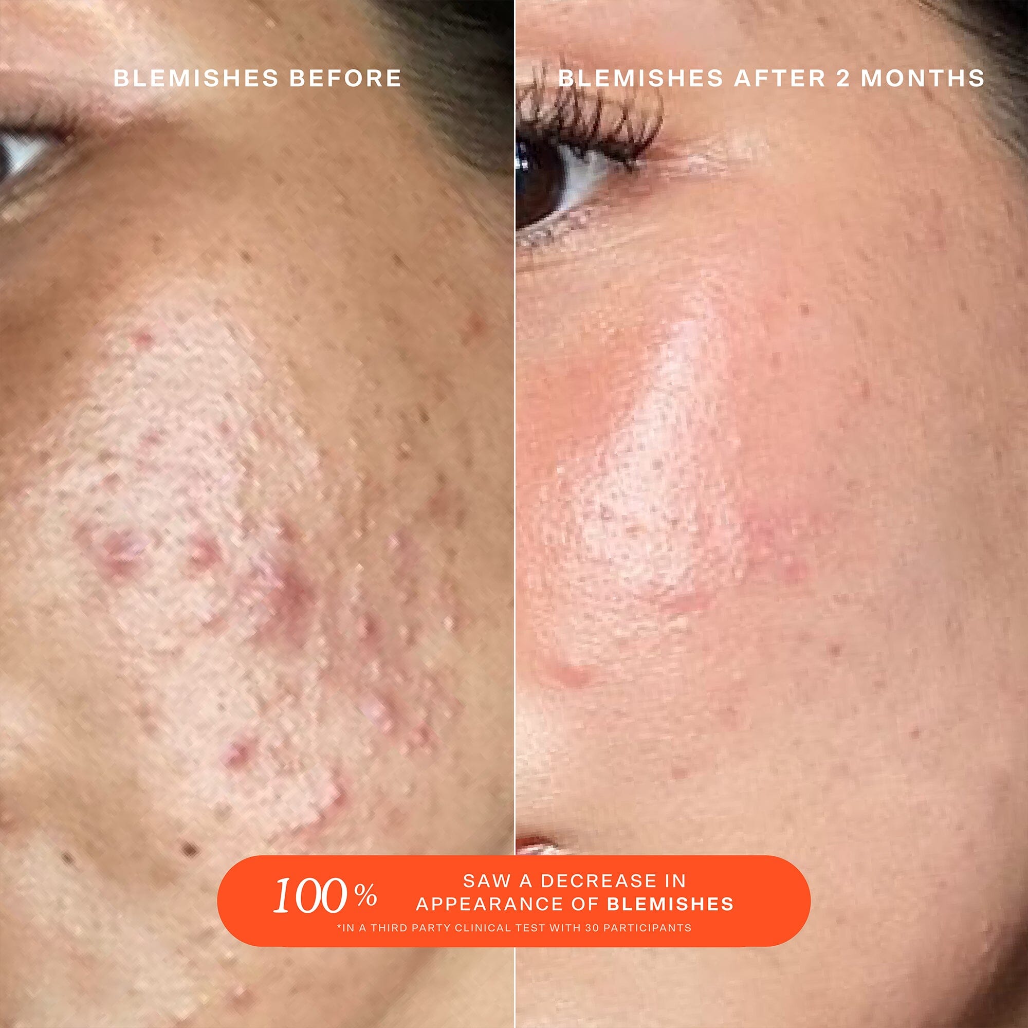 SOS Save Our Skin Daily Rescue Facial Spray with Hypochlorous Acid - Hydrating & Soothing Face Mist for Acne, Rosacea & Sensitive Skin - Perfect for Travel, Gym & Post-Workout Refresh