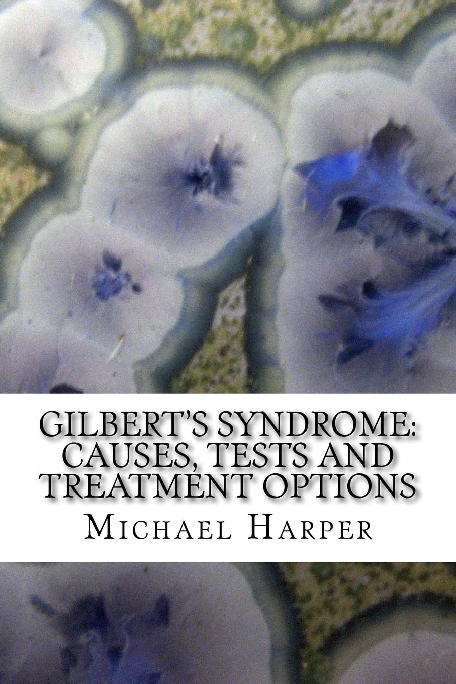 Gilbert's Syndrome: Causes, Diagnosis Tests & Effective Treatment Options - Managing Liver Disorder Symptoms for Better Health