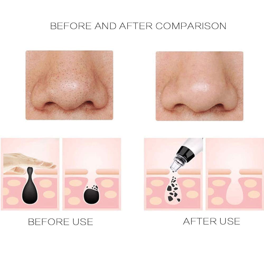 Professional Blackhead Remover Vacuum with LED Light - Pore Cleaner & Acne Extractor for Nose and Face - Skin Care Device for Deep Cleansing & Dermabrasion (White) - Perfect for Home Spa & Daily Skincare Routine