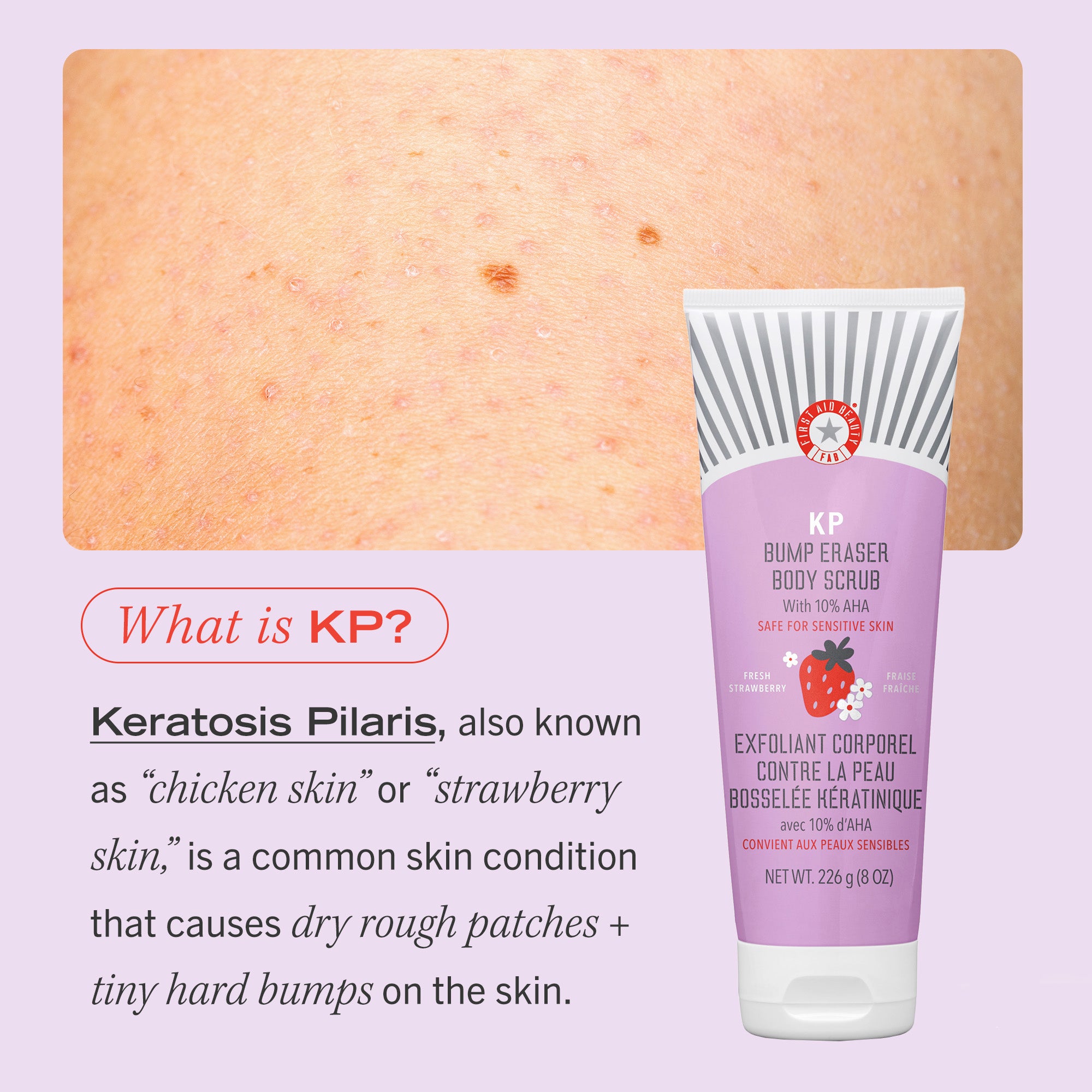 KP Bump Eraser Body Scrub with 10% AHA - Exfoliating Treatment for Keratosis Pilaris & Smooth Skin - Fresh Strawberry Scent - Perfect for Dry, Rough Skin Care Routine & Body Exfoliation