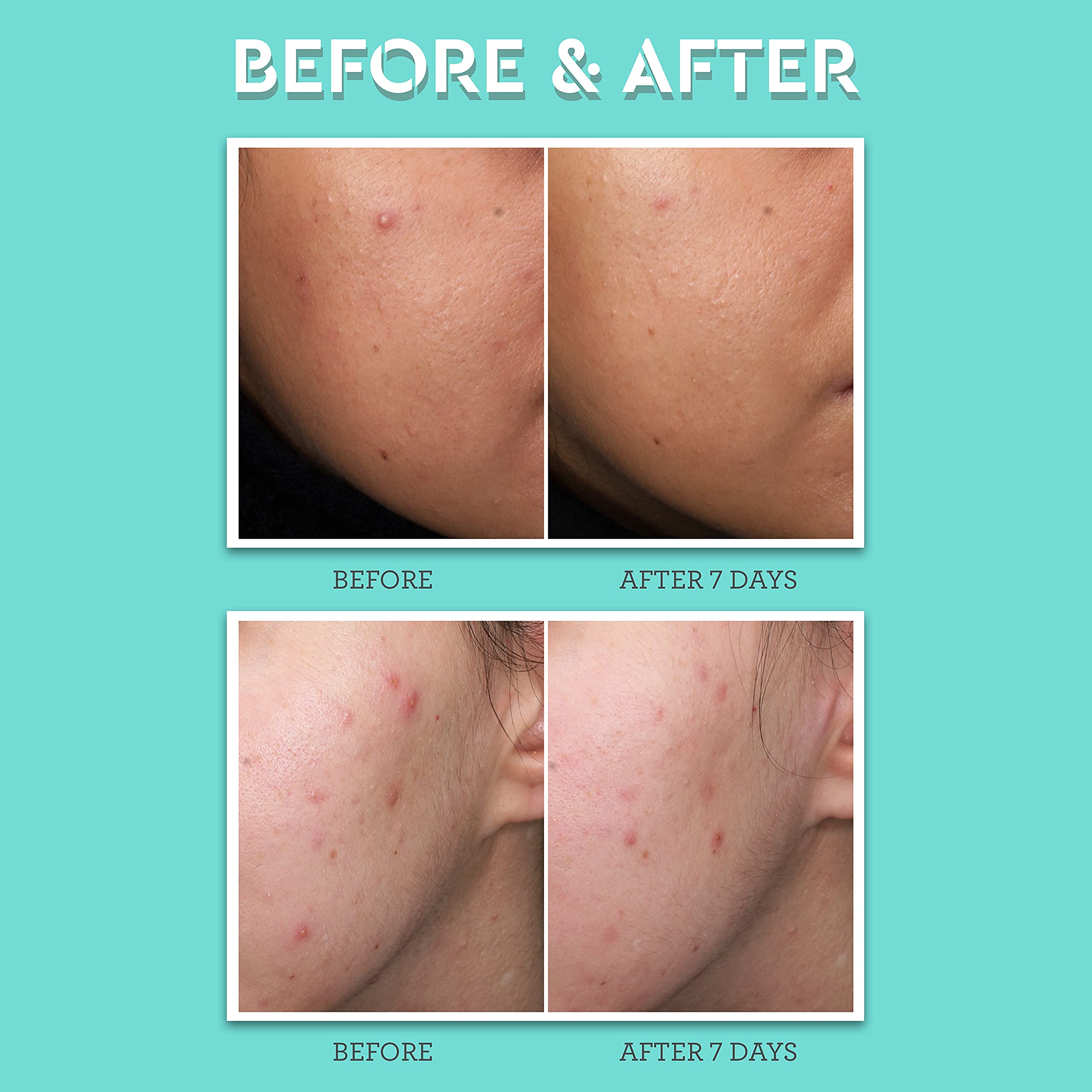 Bliss Clear Genius Acne Spot Treatment – 2% Salicylic Acid Maximum Strength for Blemish Reduction – Clean, Vegan & Cruelty-Free Formula (0.5 Fl Oz) | Perfect for Overnight Spot Treatment & Daily Acne Care