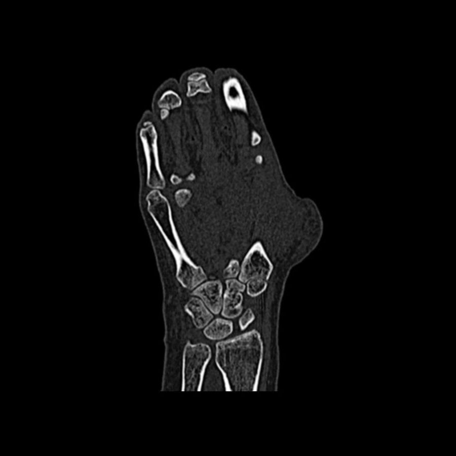 Hand Phantom Metacarpal Fractures for CT Scan & X-Ray Training - Medical Simulation Tool for Radiology Students & Emergency Practice