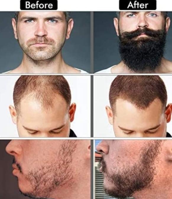 Best Hair Growth Serum for Women & Men - Natural Hair Regrowth Treatment with Biotin & Keratin - Stimulates Thicker, Longer Hair for Daily Use & Scalp Care