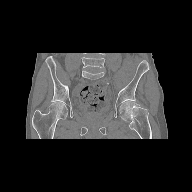 High-Quality Femoral Neck Fracture Pelvis Phantom for CT Scan & X-Ray Training - Perfect for Medical Education & Radiology Practice
