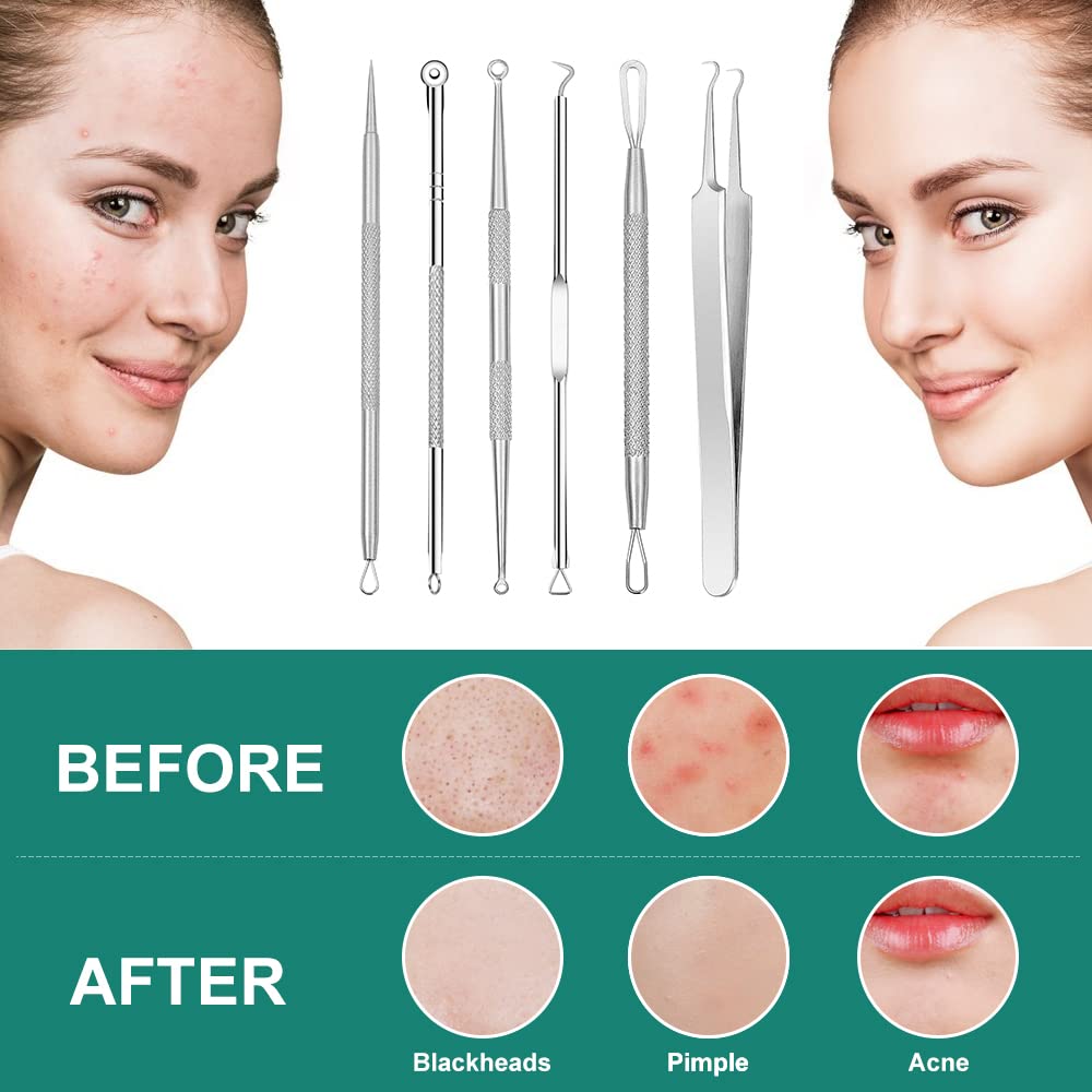Professional Blackhead Remover & Pimple Popper Tool Kit - 6-Piece Stainless Steel Acne Comedone Extractor for Blackheads, Whiteheads & Blemishes - Safe & Effective Skin Care Tools for Facial Treatment & Spa Use