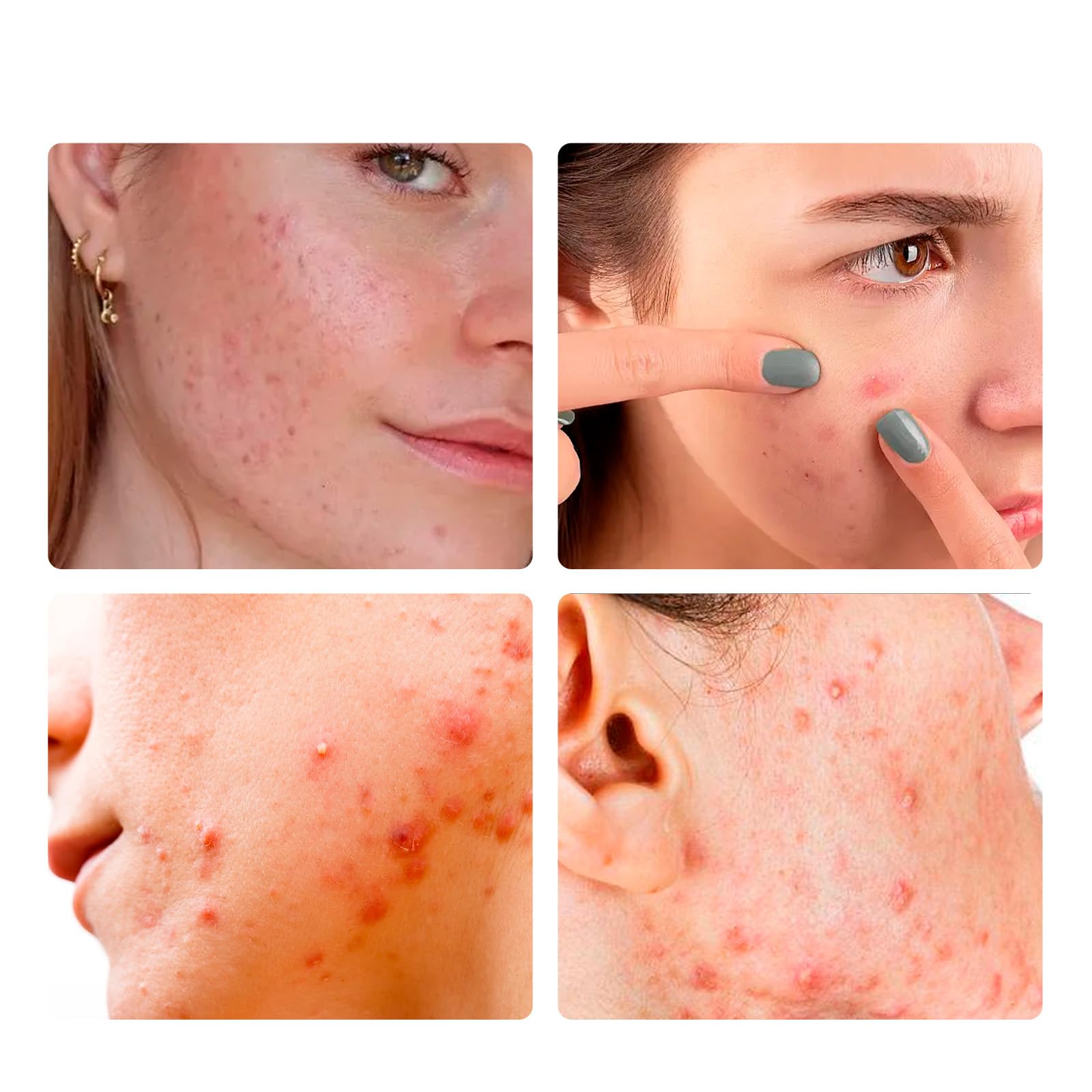 Hydrocolloid Acne Pimple Patches for Face - 36 Spot Treatment Stickers for Zits, Blemishes & Breakouts | Emergency Acne Cover for Overnight Healing & Daytime Wear | Perfect for Teens, Adults & Sensitive Skin Care Routine