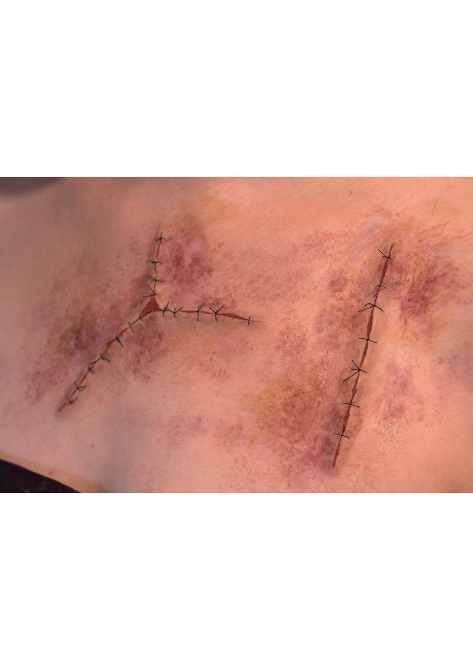 Obsidian FX Realistic Stitched Wound Prosthetic Set (2 Piece) - Perfect for Halloween, Cosplay & Special Effects Makeup